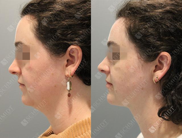 Neck Liposuction result at Schmidt Plastic Surgery in Englewood, CO