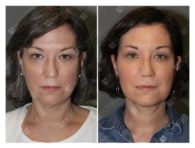 Blepharoplasty result at Schmidt Plastic Surgery in Englewood, CO