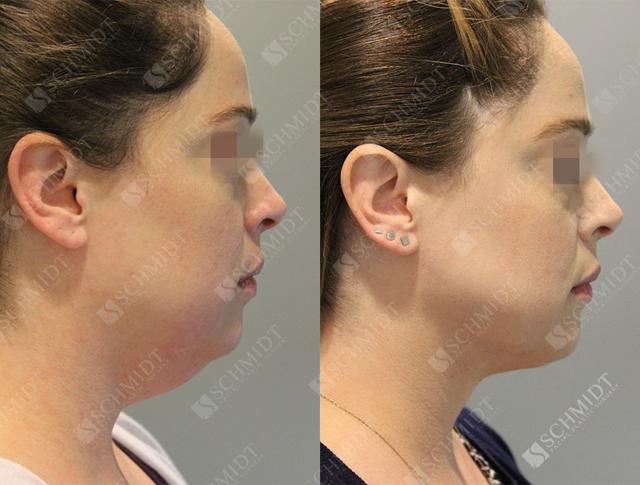 Neck Liposuction result at Schmidt Plastic Surgery in Englewood, CO