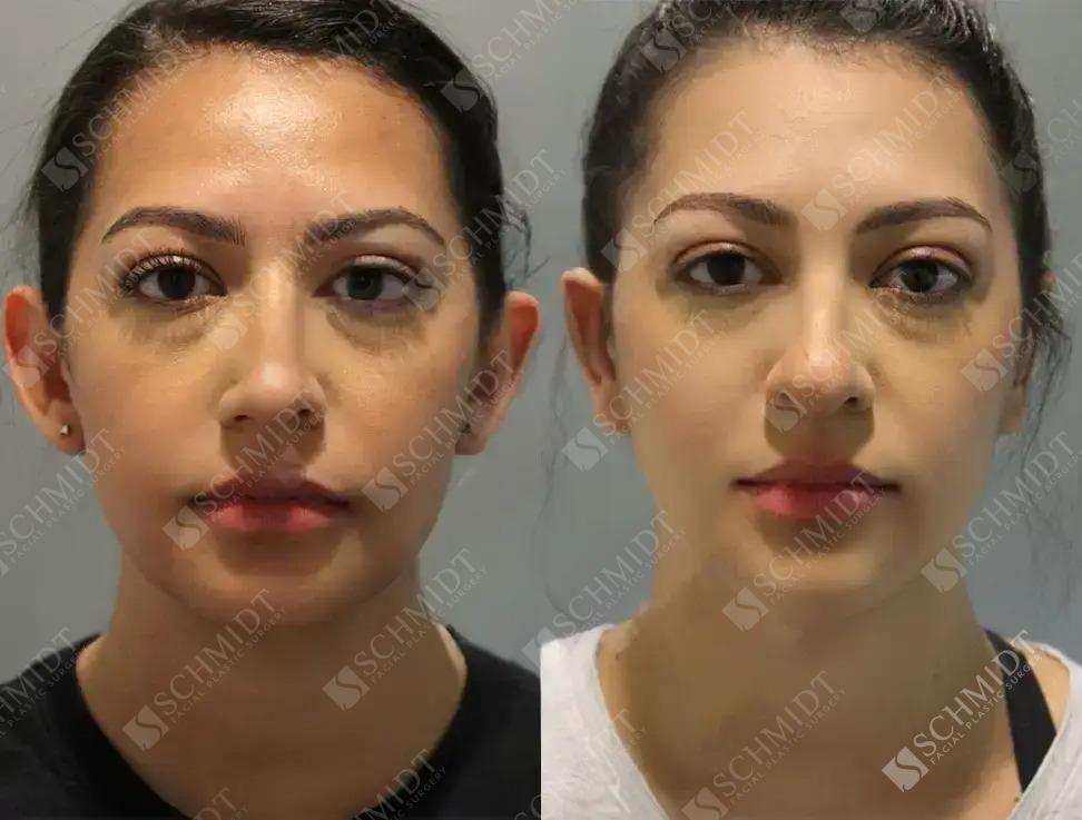 Schmidt Plastic Surgery otoplasty result — Englewood, CO