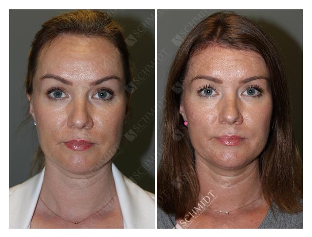 Brow Lift result at Schmidt Plastic Surgery in Englewood, CO