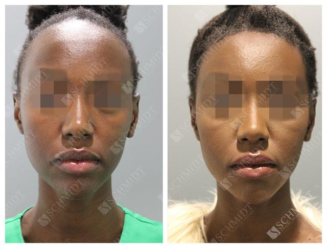Functional Rhinoplasty result at Schmidt Plastic Surgery in Englewood, CO