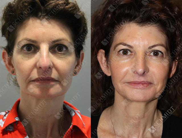 Rhinoplasty result at Schmidt Plastic Surgery in Englewood, CO