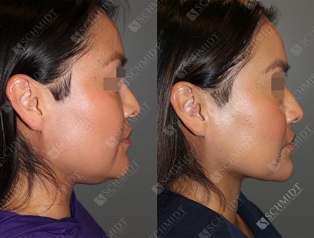 Neck Liposuction result at Schmidt Plastic Surgery in Englewood, CO