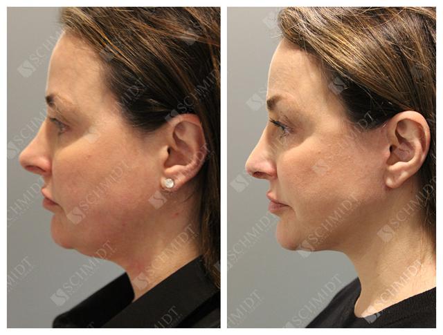 Neck Lift result at Schmidt Plastic Surgery in Englewood, CO