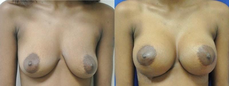 Cultura Dermatology & Plastic Surgery breast augmentation result — Washington, DC