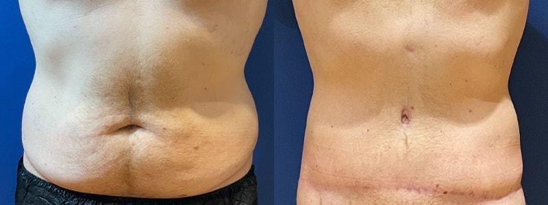 Cultura Dermatology & Plastic Surgery tummy tuck result — Washington, DC