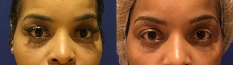Cultura Dermatology & Plastic Surgery eyelid lift result — Washington, DC