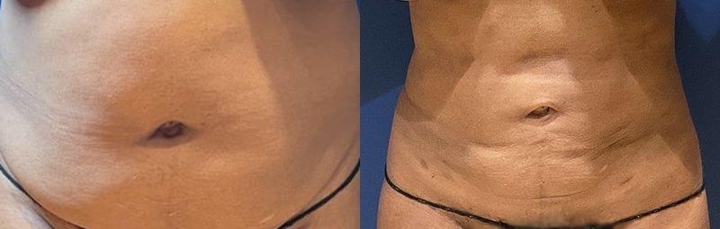 Cultura Dermatology & Plastic Surgery liposuction result — Washington, DC