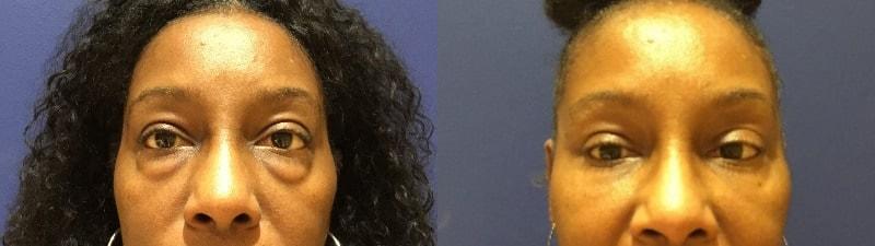 Cultura Dermatology & Plastic Surgery eyelid lift result — Washington, DC