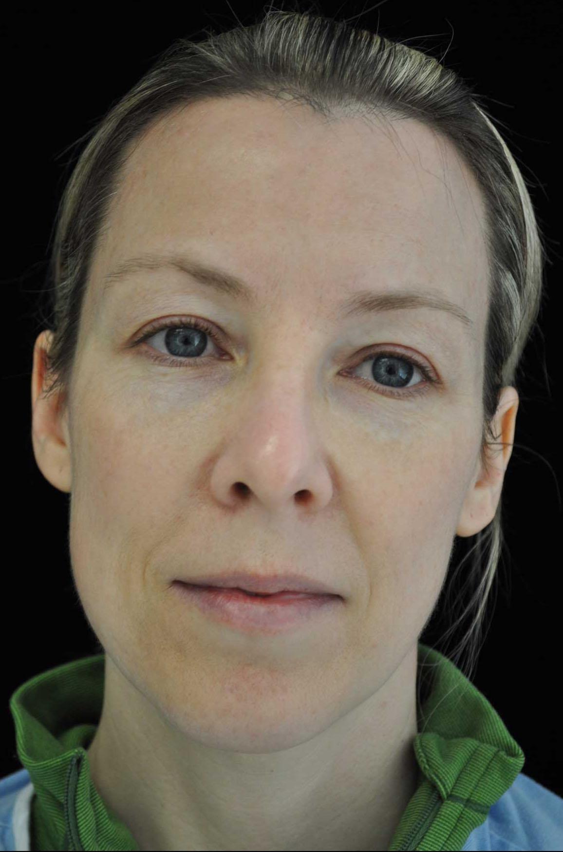 Plastic Surgery, Pittsburgh PA: Dr. Anna Wooten, Beleza Plastic Surgery & Med Spa laser treatment after — Pittsburgh, PA