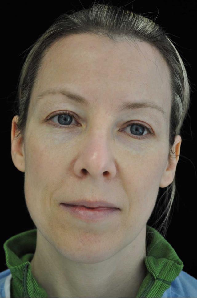 Laser Skin Resurfacing after at Plastic Surgery, Pittsburgh PA: Dr. Anna Wooten, Beleza Plastic Surgery & Med Spa in Pittsburgh, PA