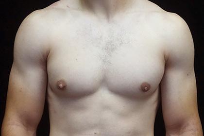 Plastic Surgery, Pittsburgh PA: Dr. Anna Wooten, Beleza Plastic Surgery & Med Spa gynecomastia after — Pittsburgh, PA