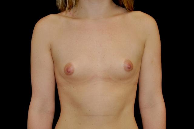 Breast Augmentation before at Plastic Surgery, Pittsburgh PA: Dr. Anna Wooten, Beleza Plastic Surgery & Med Spa in Pittsburgh, PA