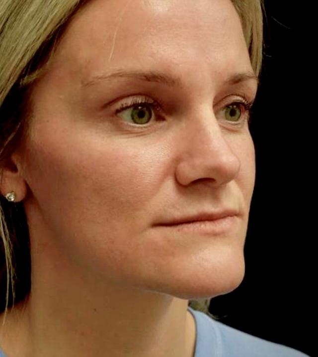 Breast Lift after at Plastic Surgery, Pittsburgh PA: Dr. Anna Wooten, Beleza Plastic Surgery & Med Spa in Pittsburgh, PA