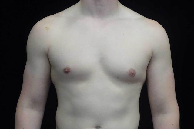 Breast Reduction before at Plastic Surgery, Pittsburgh PA: Dr. Anna Wooten, Beleza Plastic Surgery & Med Spa in Pittsburgh, PA