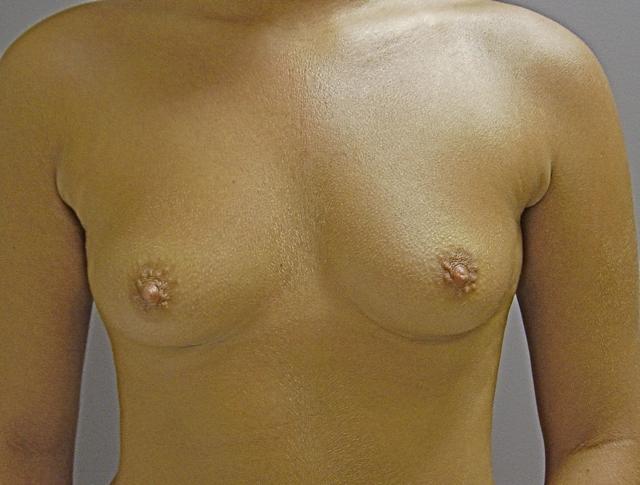Breast Augmentation before at Plastic Surgery, Pittsburgh PA: Dr. Anna Wooten, Beleza Plastic Surgery & Med Spa in Pittsburgh, PA