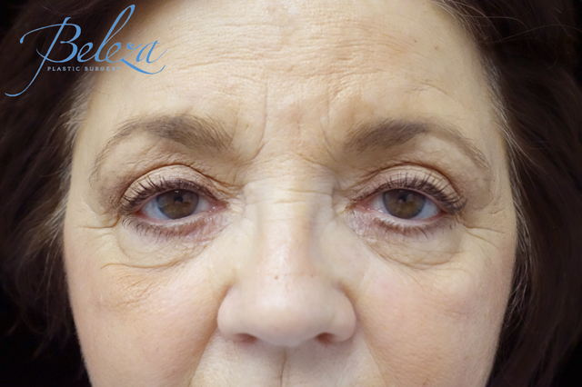 Blepharoplasty after at Plastic Surgery, Pittsburgh PA: Dr. Anna Wooten, Beleza Plastic Surgery & Med Spa in Pittsburgh, PA