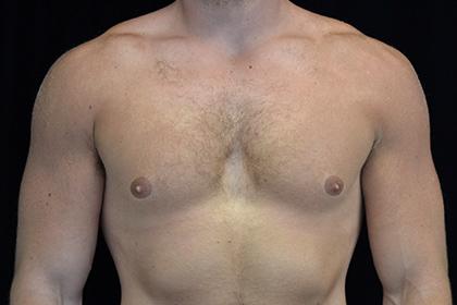 Gynecomastia Surgery before at Plastic Surgery, Pittsburgh PA: Dr. Anna Wooten, Beleza Plastic Surgery & Med Spa in Pittsburgh, PA