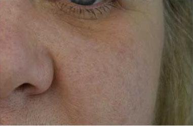 Plastic Surgery, Pittsburgh PA: Dr. Anna Wooten, Beleza Plastic Surgery & Med Spa laser treatment after — Pittsburgh, PA