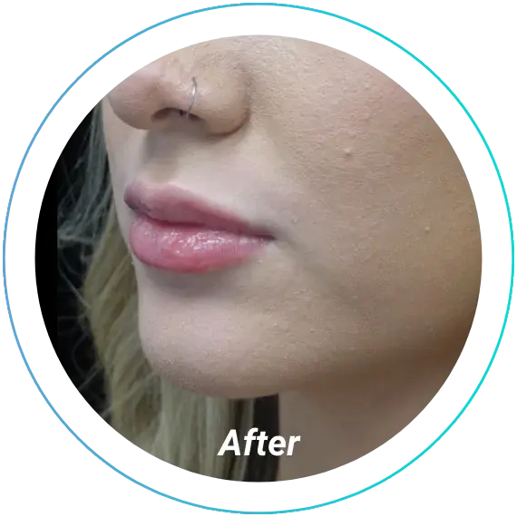 Juvederm after at Plastic Surgery, Pittsburgh PA: Dr. Anna Wooten, Beleza Plastic Surgery & Med Spa in Sewickley, PA