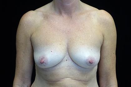 Fat Transfer before at Plastic Surgery, Pittsburgh PA: Dr. Anna Wooten, Beleza Plastic Surgery & Med Spa in Pittsburgh, PA