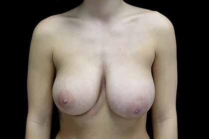 Breast Reduction before at Plastic Surgery, Pittsburgh PA: Dr. Anna Wooten, Beleza Plastic Surgery & Med Spa in Pittsburgh, PA