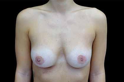 Breast Reduction after at Plastic Surgery, Pittsburgh PA: Dr. Anna Wooten, Beleza Plastic Surgery & Med Spa in Pittsburgh, PA