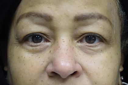 Blepharoplasty before at Plastic Surgery, Pittsburgh PA: Dr. Anna Wooten, Beleza Plastic Surgery & Med Spa in Pittsburgh, PA