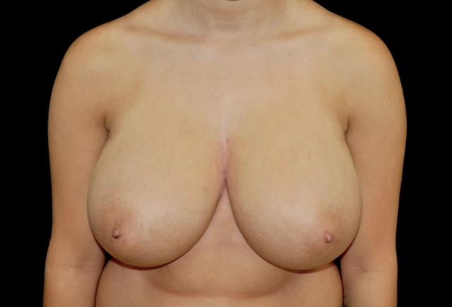 Breast Reduction before at Plastic Surgery, Pittsburgh PA: Dr. Anna Wooten, Beleza Plastic Surgery & Med Spa in Pittsburgh, PA