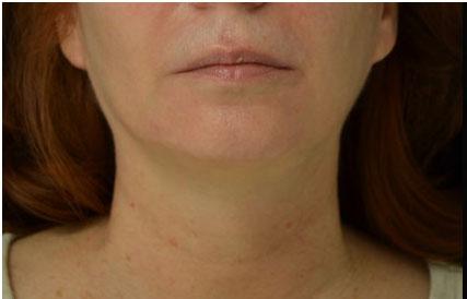 Plastic Surgery, Pittsburgh PA: Dr. Anna Wooten, Beleza Plastic Surgery & Med Spa skin tightening after — Pittsburgh, PA