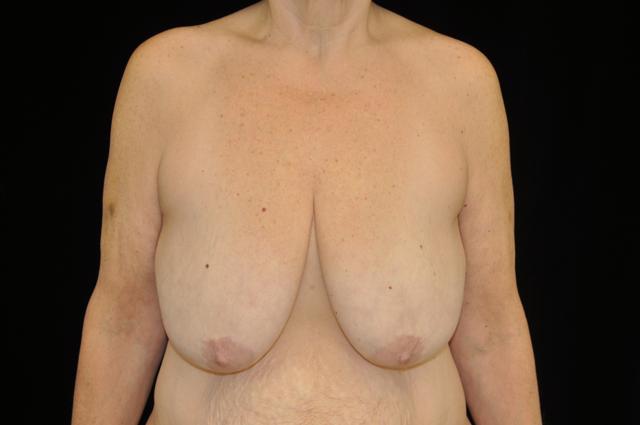 Breast Reduction before at Plastic Surgery, Pittsburgh PA: Dr. Anna Wooten, Beleza Plastic Surgery & Med Spa in Pittsburgh, PA