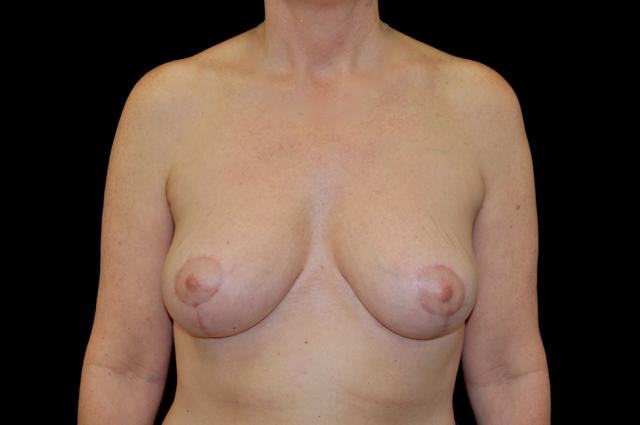 Breast Lift after at Plastic Surgery, Pittsburgh PA: Dr. Anna Wooten, Beleza Plastic Surgery & Med Spa in Pittsburgh, PA