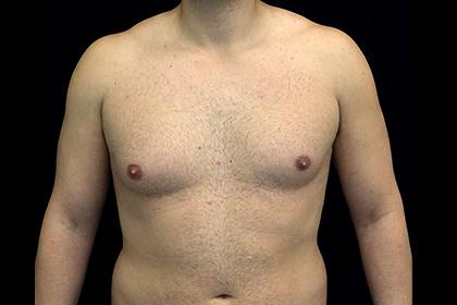 Gynecomastia Surgery before at Plastic Surgery, Pittsburgh PA: Dr. Anna Wooten, Beleza Plastic Surgery & Med Spa in Pittsburgh, PA