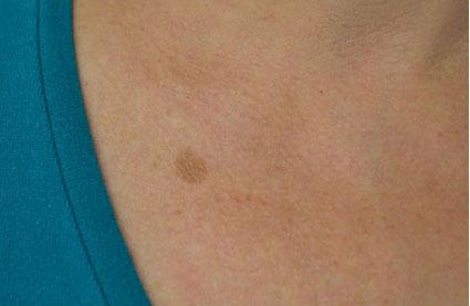 Laser Skin Resurfacing before at Plastic Surgery, Pittsburgh PA: Dr. Anna Wooten, Beleza Plastic Surgery & Med Spa in Pittsburgh, PA