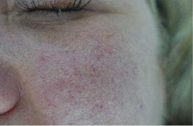 Laser Skin Resurfacing before at Plastic Surgery, Pittsburgh PA: Dr. Anna Wooten, Beleza Plastic Surgery & Med Spa in Pittsburgh, PA