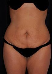 Tummy Tuck before at Plastic Surgery, Pittsburgh PA: Dr. Anna Wooten, Beleza Plastic Surgery & Med Spa in Pittsburgh, PA