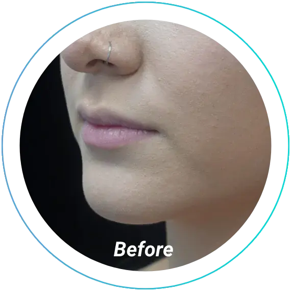 Juvederm before at Plastic Surgery, Pittsburgh PA: Dr. Anna Wooten, Beleza Plastic Surgery & Med Spa in Sewickley, PA