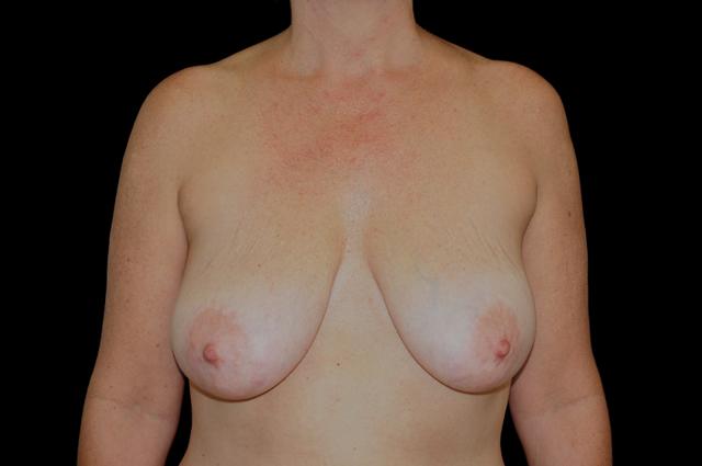 Breast Lift before at Plastic Surgery, Pittsburgh PA: Dr. Anna Wooten, Beleza Plastic Surgery & Med Spa in Pittsburgh, PA