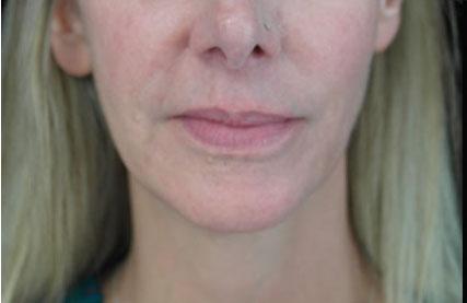 Plastic Surgery, Pittsburgh PA: Dr. Anna Wooten, Beleza Plastic Surgery & Med Spa skin tightening after — Pittsburgh, PA