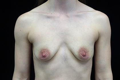 Fat Transfer before at Plastic Surgery, Pittsburgh PA: Dr. Anna Wooten, Beleza Plastic Surgery & Med Spa in Pittsburgh, PA