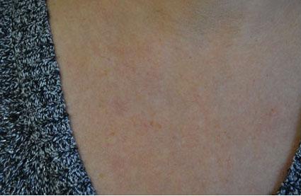 Plastic Surgery, Pittsburgh PA: Dr. Anna Wooten, Beleza Plastic Surgery & Med Spa laser treatment after — Pittsburgh, PA