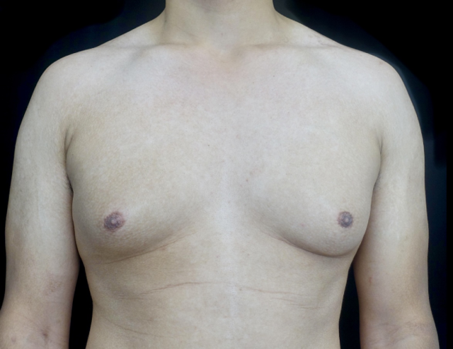 Gynecomastia Surgery before at Plastic Surgery, Pittsburgh PA: Dr. Anna Wooten, Beleza Plastic Surgery & Med Spa in Pittsburgh, PA