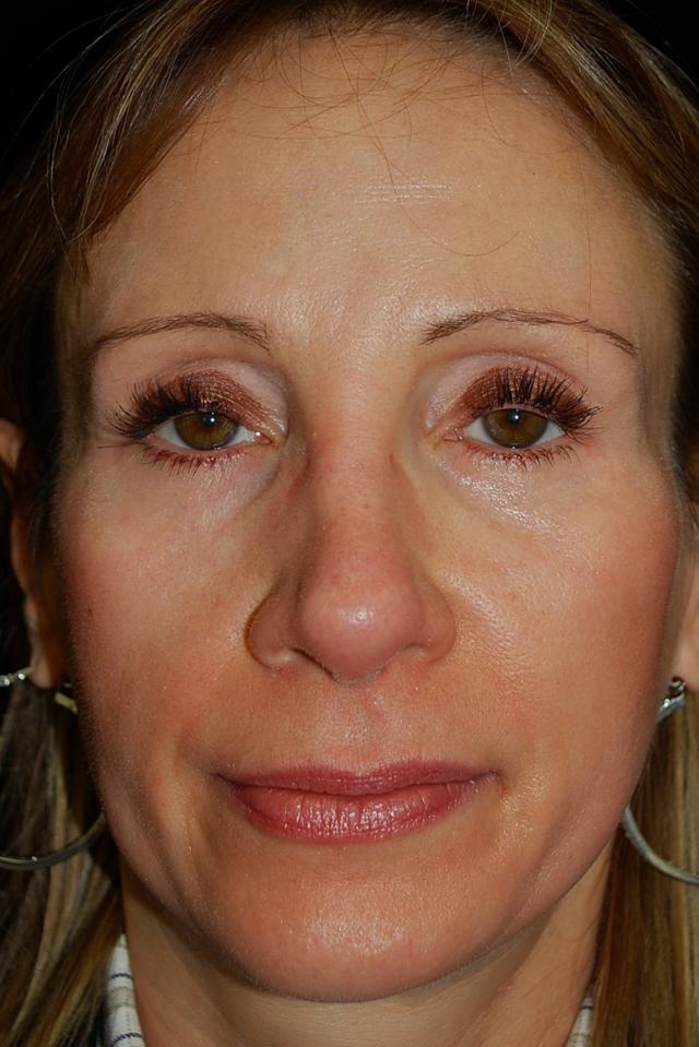 Fat Transfer before at Plastic Surgery, Pittsburgh PA: Dr. Anna Wooten, Beleza Plastic Surgery & Med Spa in Pittsburgh, PA