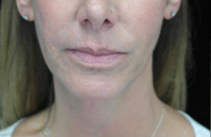 Laser Skin Resurfacing before at Plastic Surgery, Pittsburgh PA: Dr. Anna Wooten, Beleza Plastic Surgery & Med Spa in Pittsburgh, PA