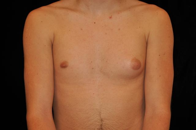 Gynecomastia Surgery before at Plastic Surgery, Pittsburgh PA: Dr. Anna Wooten, Beleza Plastic Surgery & Med Spa in Pittsburgh, PA