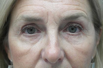 Blepharoplasty after at Plastic Surgery, Pittsburgh PA: Dr. Anna Wooten, Beleza Plastic Surgery & Med Spa in Pittsburgh, PA
