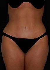 Tummy Tuck after at Plastic Surgery, Pittsburgh PA: Dr. Anna Wooten, Beleza Plastic Surgery & Med Spa in Pittsburgh, PA