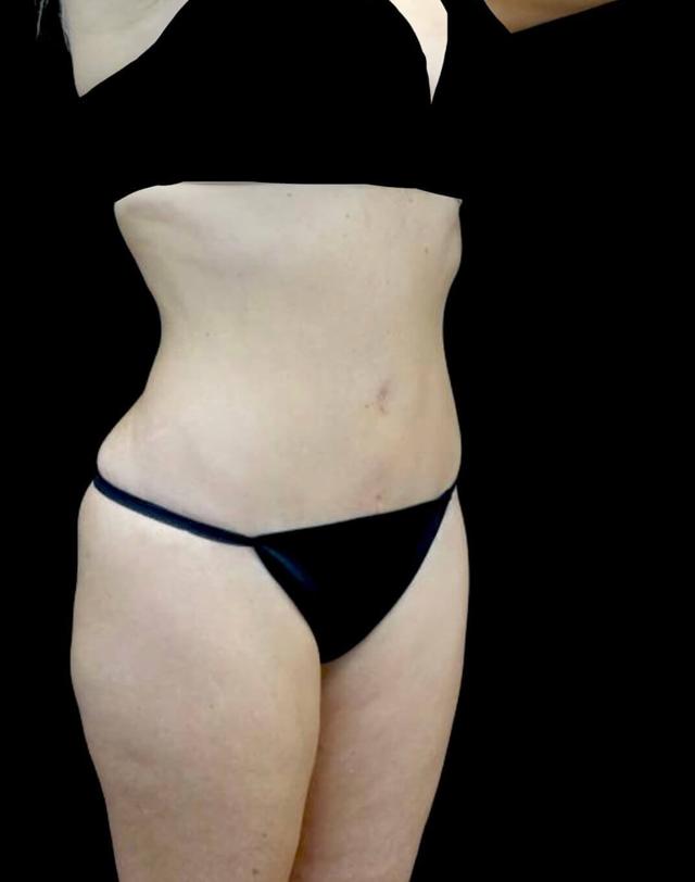 Tummy Tuck after at Plastic Surgery, Pittsburgh PA: Dr. Anna Wooten, Beleza Plastic Surgery & Med Spa in Pittsburgh, PA