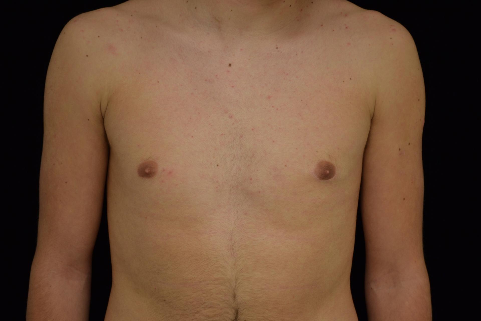 Plastic Surgery, Pittsburgh PA: Dr. Anna Wooten, Beleza Plastic Surgery & Med Spa gynecomastia after — Pittsburgh, PA